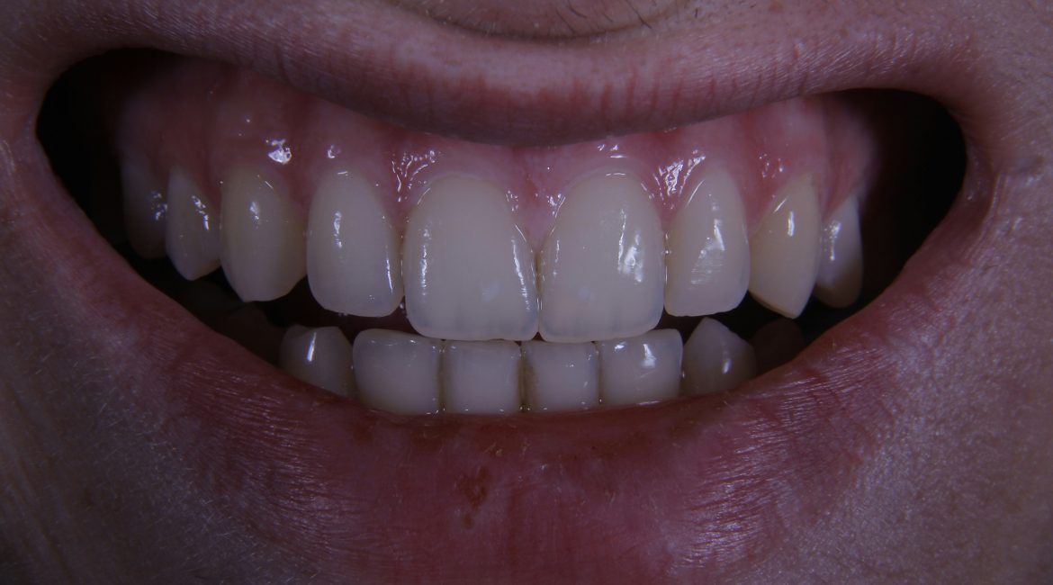 Apa Efek Samping Veneer Gigi? Berapa Biayanya?