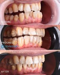 Clear Aligner Itu Apa? Kenali Inovasi Rapikan Gigi Tanpa Kawat
