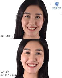 Pantangan Setelah Bleaching Gigi Agar Putihnya Tahan Lama!