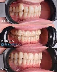 kawat gigi invisalign