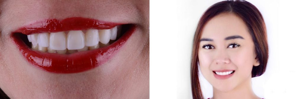 pasang veneer gigi