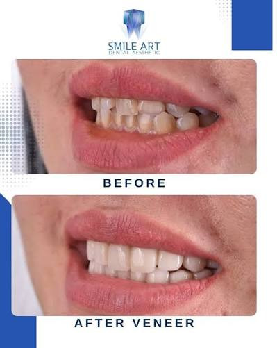veneer gigi lepas